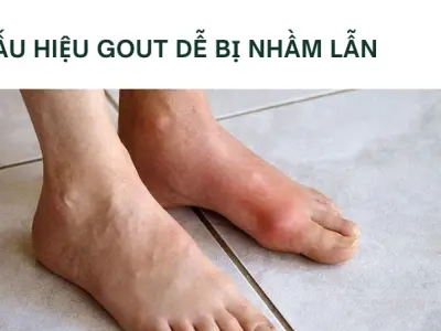 Cách nhận biết bệnh gout từ dấu hiệu sớm để điều trị kịp thời