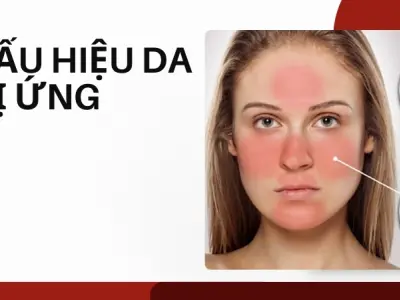 Da mặt mẩn đỏ, ngứa ngáy- Cách tôi phân biệt và xử lý