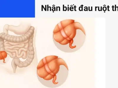 Trải nghiệm nhận biết dấu hiệu đau ruột thừa chuẩn xác nhất