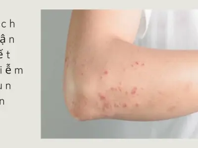 Dấu hiệu nhiễm giun sán và cách nhận biết và khi nào cần tẩy