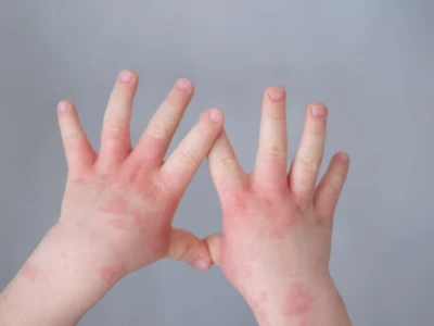 Bé Bị Nổi Mề Đay: Tổng Hợp Mẹo Chữa Trị An Toàn Tại Nhà Cho Trẻ