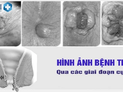 Bệnh trĩ: Nguyên nhân, triệu chứng và cách điều trị hiệu quả