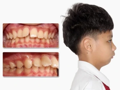 Cằm lẹm là gì? Dấu hiệu, nguyên nhân và cách khắc phục hiệu quả