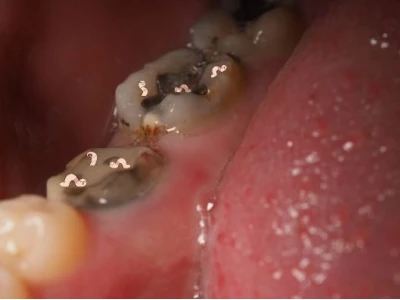 Con sâu răng là gì? Phân biệt với các bệnh lý răng miệng thường gặp