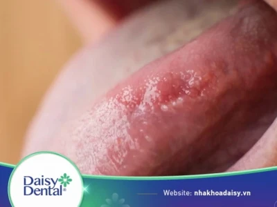 Lưỡi bình thường như thế nào và những dấu hiệu cần lưu ý