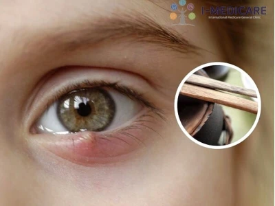 Mẹo chữa lẹo mắt bằng đũa: Hiệu quả hay chỉ là truyền miệng?