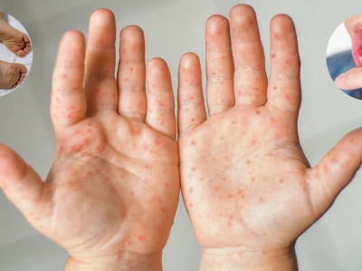 Mẹo Dân Gian Chữa Bệnh Chân Tay Miệng Hiệu Quả Cho Trẻ