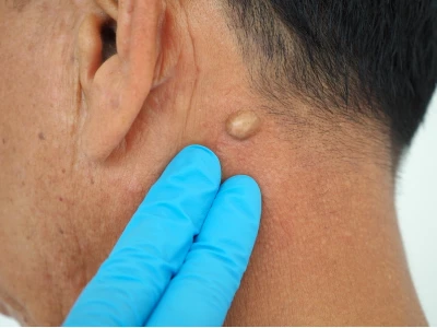 Mẹo dân gian chữa u bã đậu: Liệu có an toàn và hiệu quả?