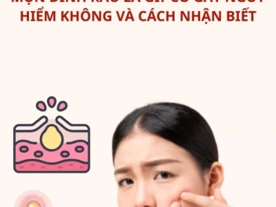 Mụn đầu đinh: Mẹo chữa dân gian hiệu quả và cách phòng tránh tại nhà