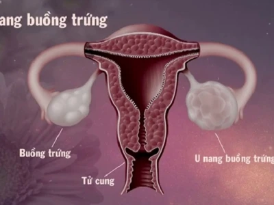 Nang cơ năng buồng trứng là gì và những điều cần biết