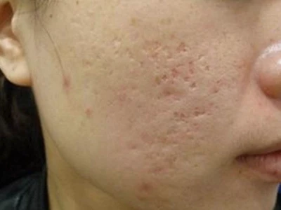 Sẹo Rỗ Là Gì? Nguyên Nhân, Dấu Hiệu và Cách Phân Loại