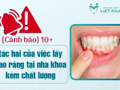 Tác hại của việc lấy cao răng: Những điều bạn cần biết để bảo vệ sức khỏe răng miệng