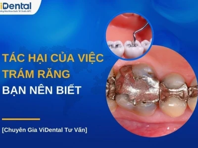 Tác hại của việc trám răng: Nhận diện và cách phòng ngừa hiệu quả