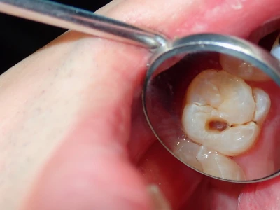 Tác hại khôn lường khi không nhổ răng sâu