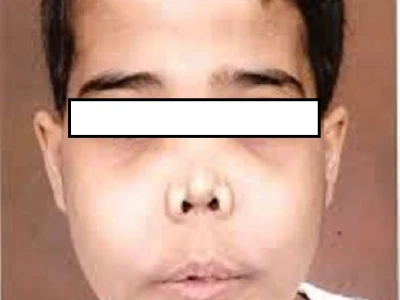 Tan máu bẩm sinh là gì? Nguyên nhân, dấu hiệu và cách điều trị hiệu quả
