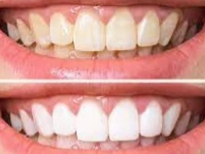 Tẩy trắng răng tiềm ẩn những tác hại không ngờ tới